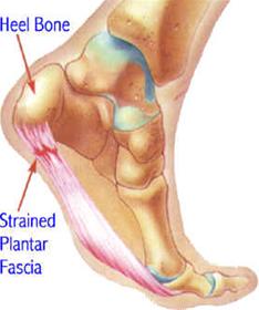  درمان خارپاشنه (Heel Spur) کلینیک تخصصی پا تکنوفوت